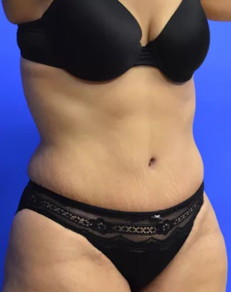 Drainless Tummy Tuck Before & After Gallery - Patient 367985 - Image 4