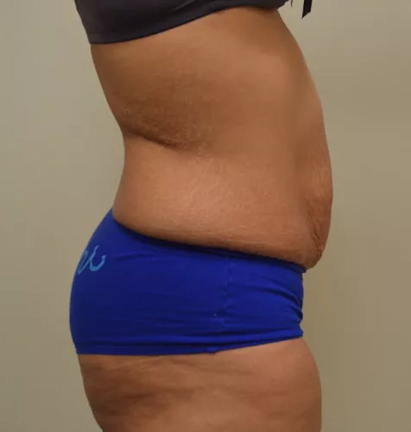 Drainless Tummy Tuck Before & After Gallery - Patient 367985 - Image 5