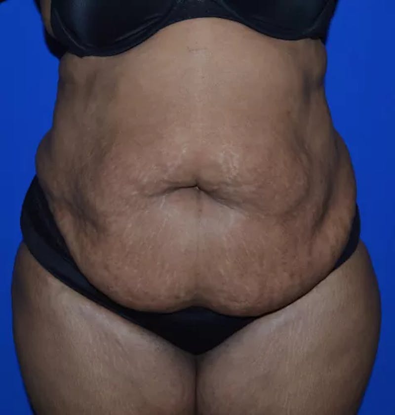 Drainless Tummy Tuck Before & After Gallery - Patient 196633 - Image 1