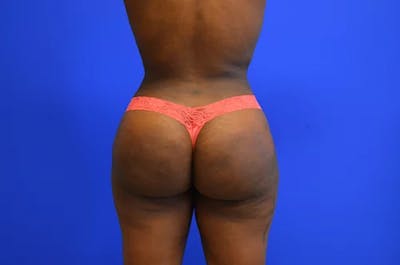 Brazilian Butt Lift Before & After Gallery - Patient 466789 - Image 2