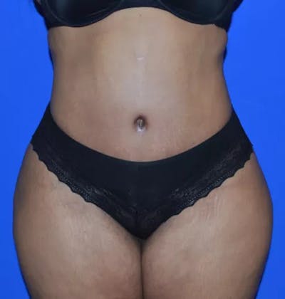 Drainless Tummy Tuck Before & After Gallery - Patient 196633 - Image 2