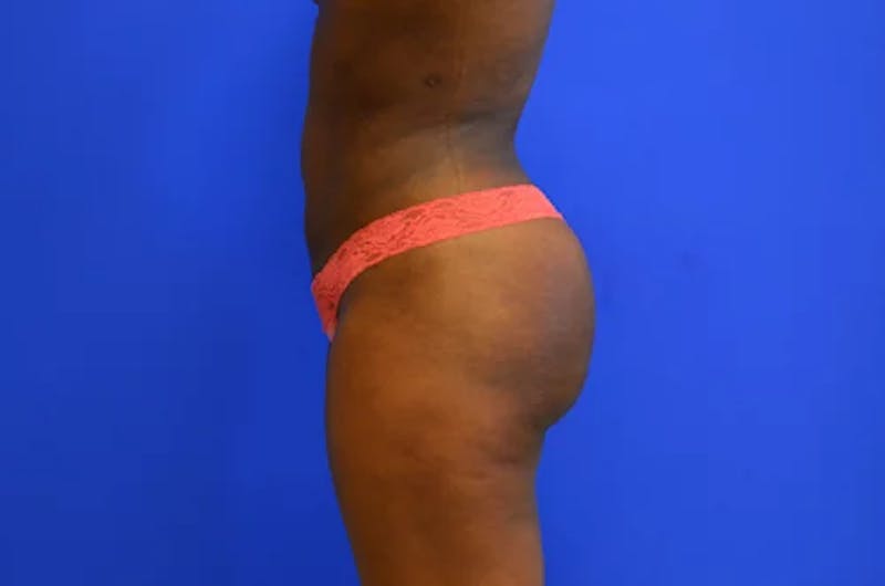Brazilian Butt Lift Before & After Gallery - Patient 466789 - Image 4