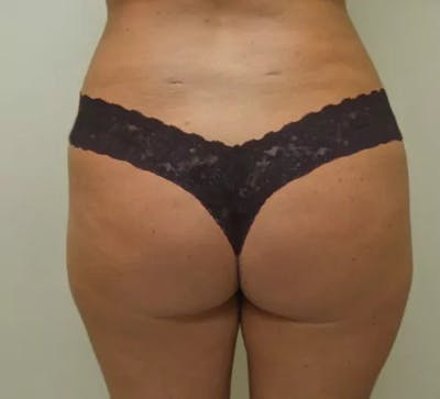 Brazilian Butt Lift Before & After Gallery - Patient 184179 - Image 1