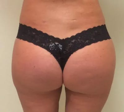 Brazilian Butt Lift Before & After Gallery - Patient 184179 - Image 2
