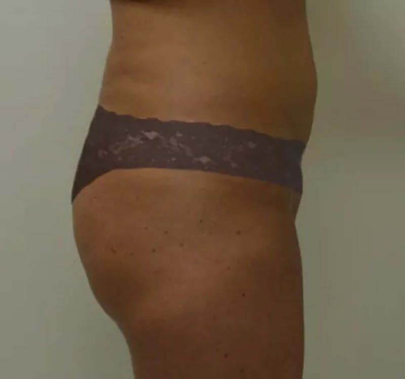 Brazilian Butt Lift Before & After Gallery - Patient 184179 - Image 3