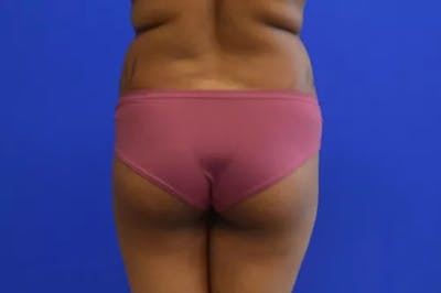 Brazilian Butt Lift Before & After Gallery - Patient 155565 - Image 1