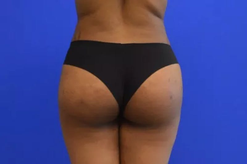 Brazilian Butt Lift Before & After Gallery - Patient 155565 - Image 2