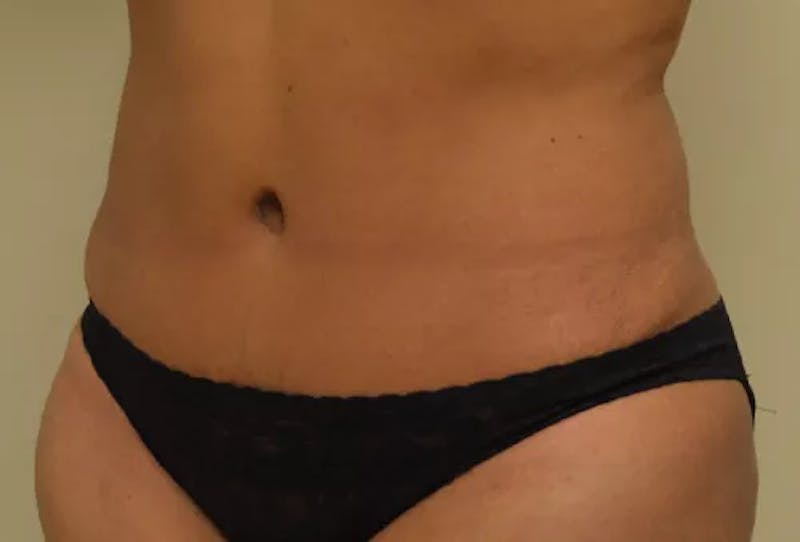 Drainless Tummy Tuck Before & After Gallery - Patient 249745 - Image 4