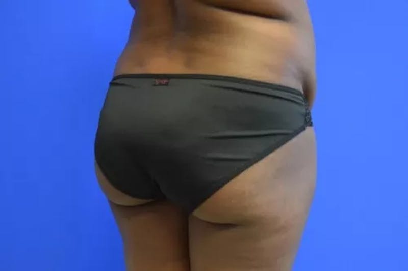 Brazilian Butt Lift Before & After Gallery - Patient 386701 - Image 1