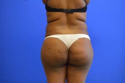 Brazilian Butt Lift Before & After Gallery - Patient 165496 - Image 1