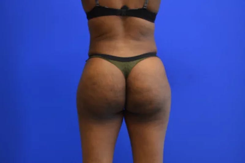 Brazilian Butt Lift Before & After Gallery - Patient 165496 - Image 2