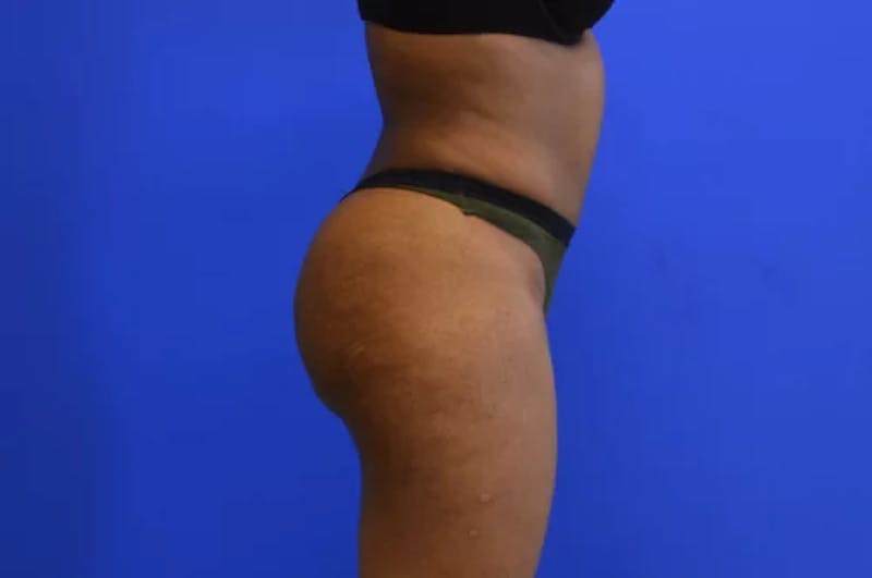 Brazilian Butt Lift Before & After Gallery - Patient 165496 - Image 4