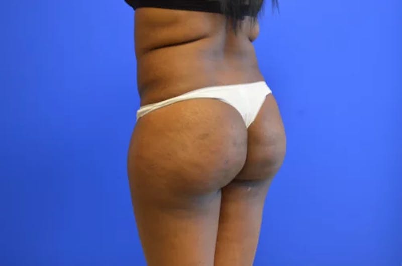 Brazilian Butt Lift Before & After Gallery - Patient 165496 - Image 5