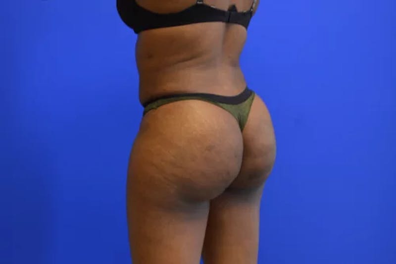 Brazilian Butt Lift Before & After Gallery - Patient 165496 - Image 6