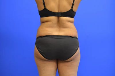 Brazilian Butt Lift Before & After Gallery - Patient 208556 - Image 1