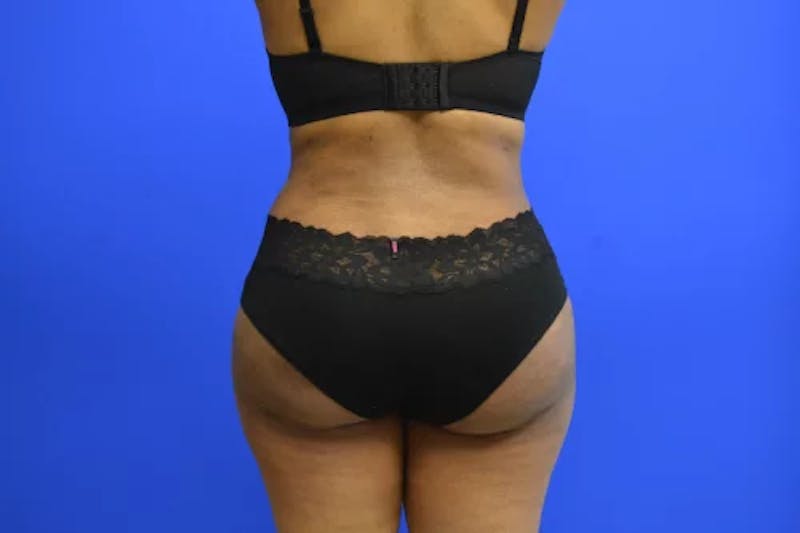 Brazilian Butt Lift Before & After Gallery - Patient 208556 - Image 2