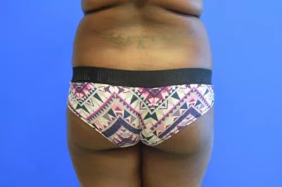 Brazilian Butt Lift Before & After Gallery - Patient 304705 - Image 1