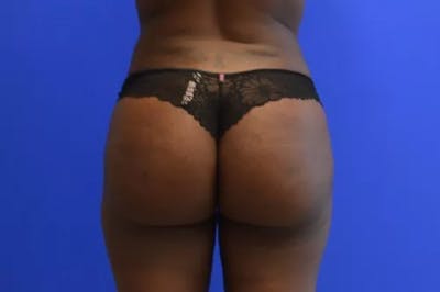 Brazilian Butt Lift Before & After Gallery - Patient 304705 - Image 2