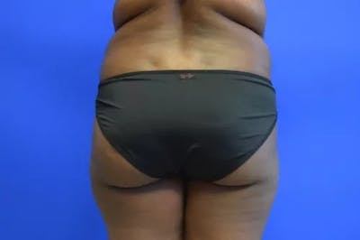 Brazilian Butt Lift Before & After Gallery - Patient 225363 - Image 1