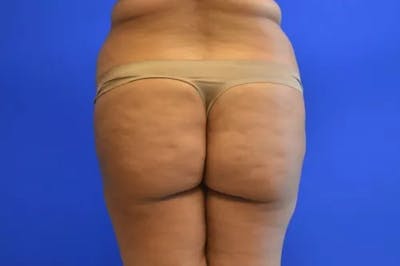 Brazilian Butt Lift Before & After Gallery - Patient 170801 - Image 1