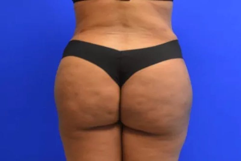 Brazilian Butt Lift Before & After Gallery - Patient 170801 - Image 2