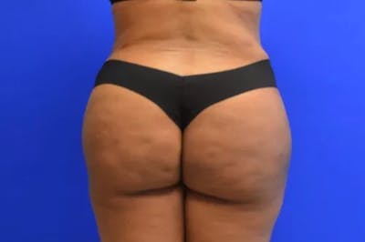 Brazilian Butt Lift Before & After Gallery - Patient 170801 - Image 2