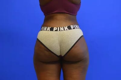 Brazilian Butt Lift Before & After Gallery - Patient 298200 - Image 2
