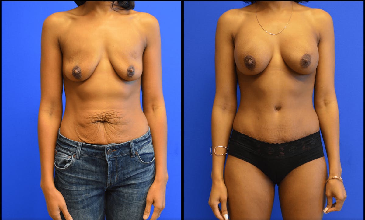 Her Body, Her Soul Before & After Gallery - Patient 166683 - Image 4