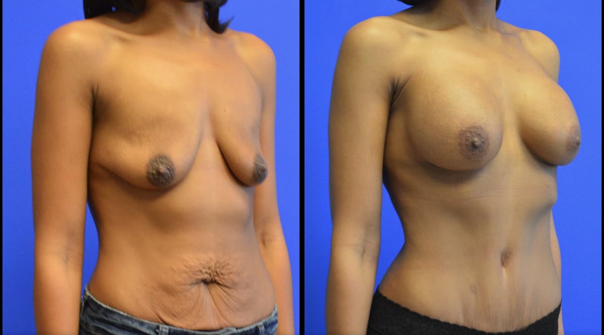 Her Body, Her Soul Before & After Gallery - Patient 166683 - Image 6