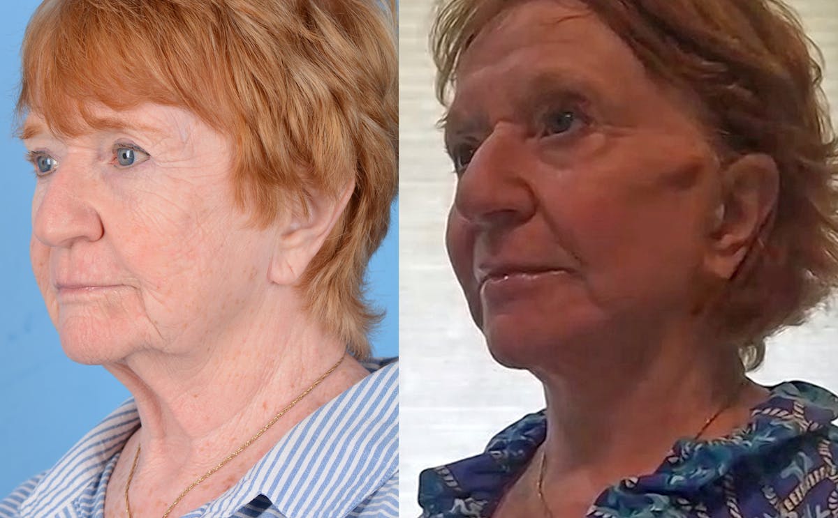 before/after