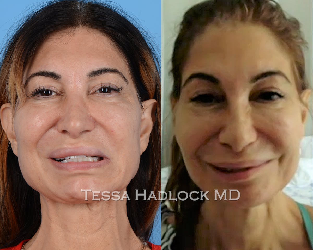 before/after