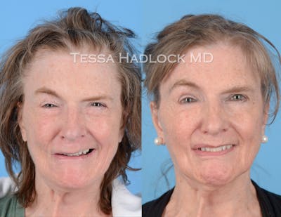 Gracilis Before & After Gallery - Patient 105997 - Image 1