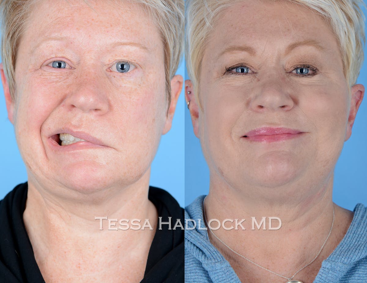 before/after