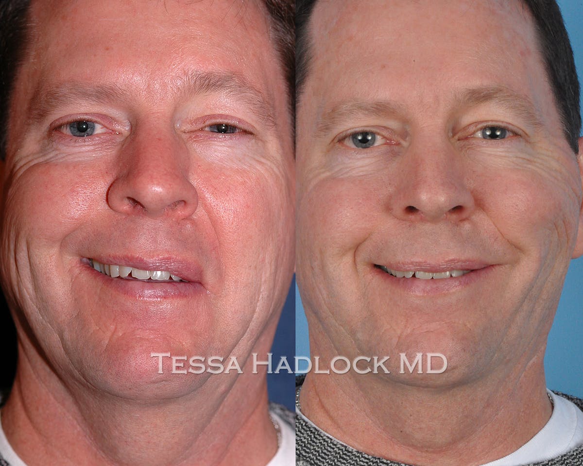 before/after