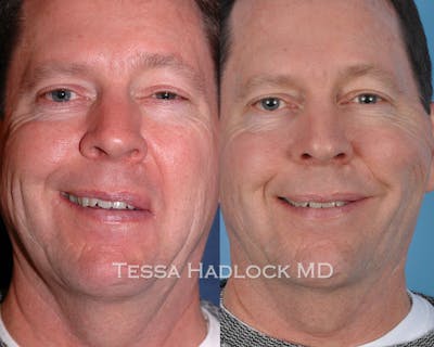 before/after