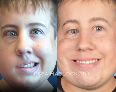 before/after