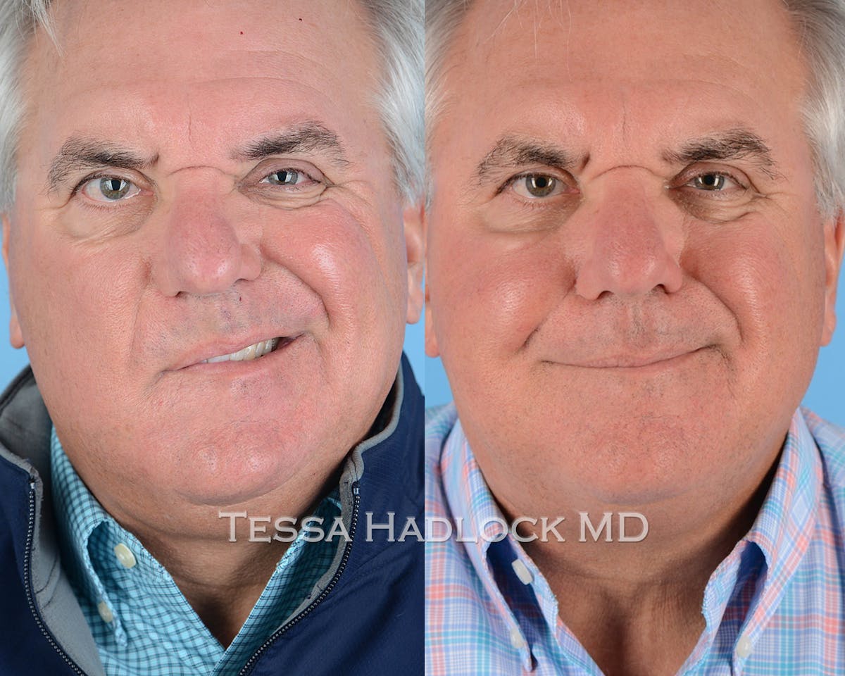 before/after