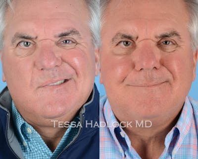 before/after