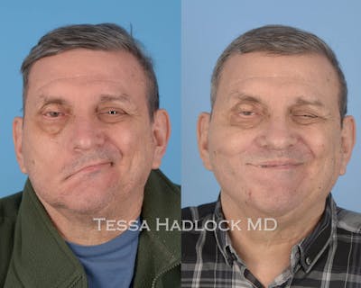 before/after