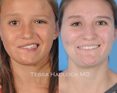 before/after