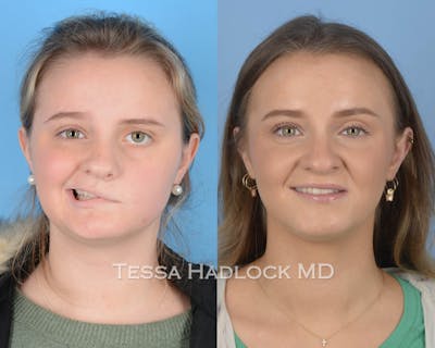 before/after
