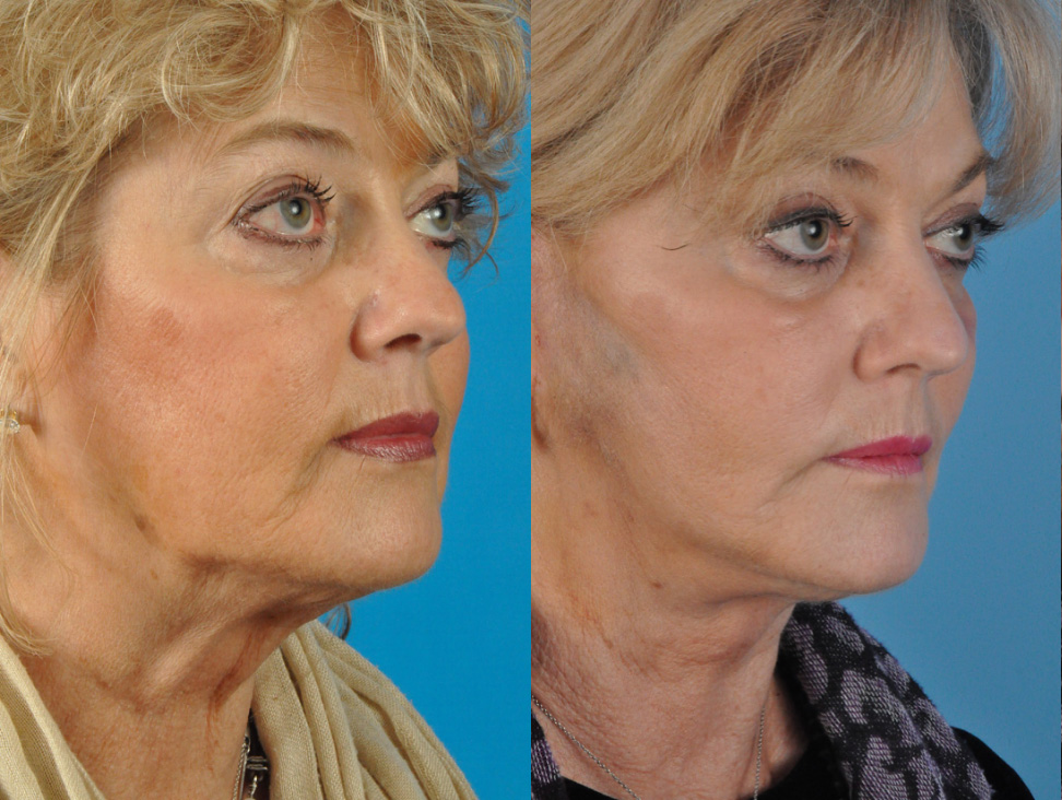 Office Facelift Before & After Gallery - Patient 216367 - Image 2