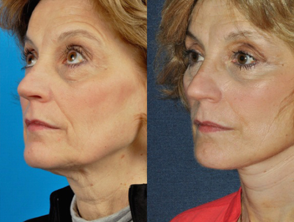 Office Facelift Before & After Gallery - Patient 193047 - Image 2
