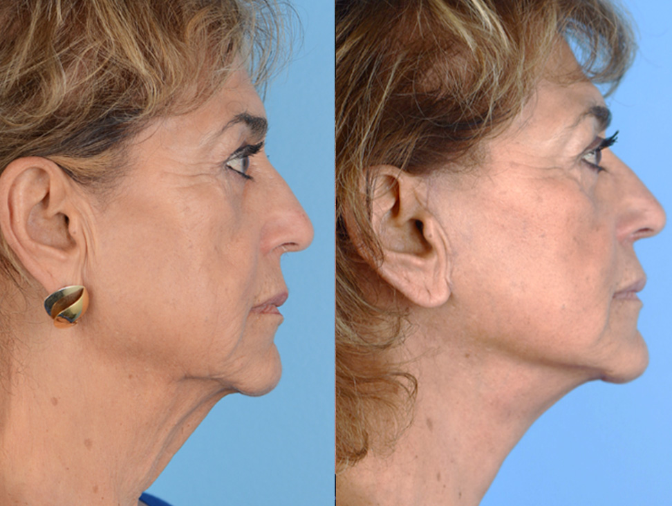 Office Facelift Before & After Gallery - Patient 325398 - Image 3