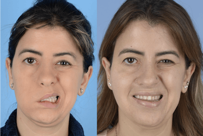 Gracilis Before & After Gallery - Patient 298059 - Image 1