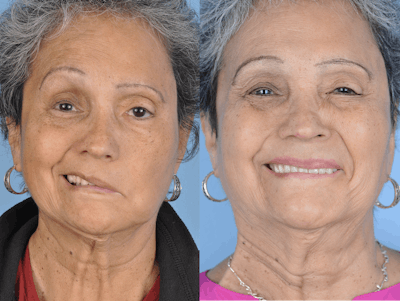 Facial Nerve Repair/Reinnervation Before & After Gallery - Patient 288879 - Image 1
