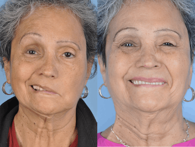 Reinnervation/Nerve Transfers Before & After Gallery - Patient 288879 - Image 1