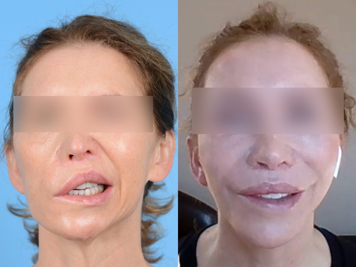Reinnervation/Nerve Transfers Before & After Gallery - Patient 415410 - Image 1