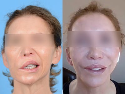 Facial Nerve Repair/Reinnervation Before & After Gallery - Patient 415410 - Image 1
