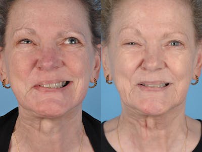 Facial Nerve Repair/Reinnervation Before & After Gallery - Patient 206434 - Image 1